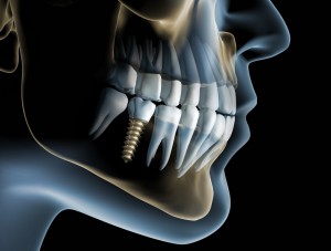 implantologia osteo-integrata