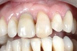 01. situazione iniziale con dente ancora da estrarre