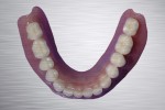 02 overdenture inferiore su impianti