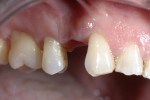 03 - 5 mesi dopo guarigione avvenuta