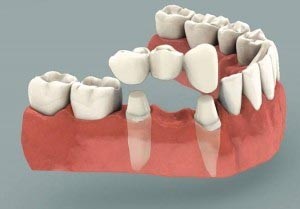 Ponte su denti naturali