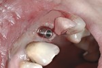 03. impianto inserito al posto del dente estratto