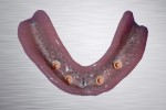 03 overdenture inferiore su impianti