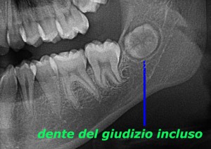 Dente del giudizio incluso