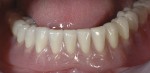 04 overdenture inferiore su impianti