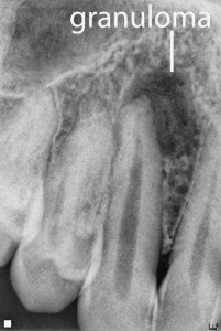 RX granuloma apicale