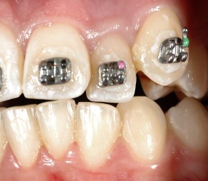 affollamento dentario superiore