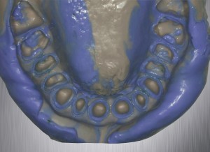 impronta in silicone dell’arcata dentaria