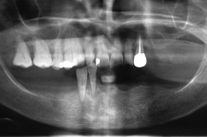 panoramica dentaria OPT