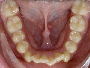 affollamento dentario inferiore