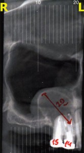 cisti odontogena immagine TAC