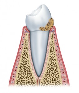 tartaro sopragengivale