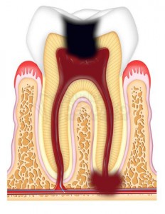 necrosi della polpa e granuloma apicale