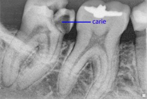 RX di un molare inferiore cariato