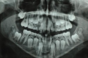 RX panoramica dentaria