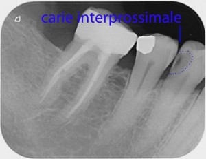 RX carie interprossimale