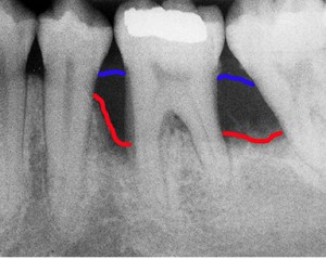 parodonto malato livello osseo basso