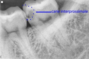 carie interprossimale