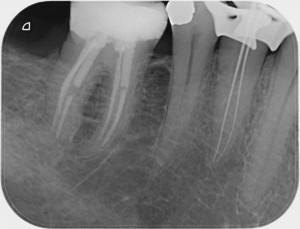 misurazione lunghezza dei canali del dente