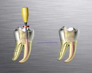 otturazione del canale con un cono di guttaperca