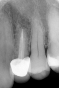 RX dopo la cura e la ricopertura del dente