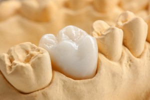 corona in ceramica
