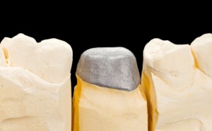 struttura matallica della corona protesica