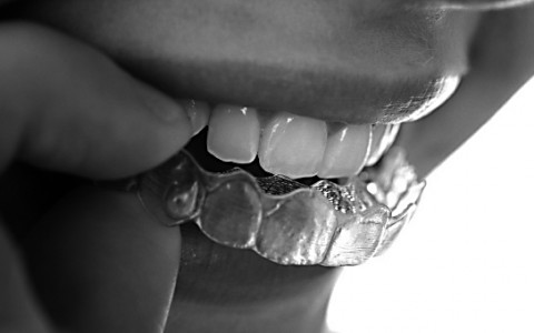 mascherina trasparente per ortodonzia invisibile